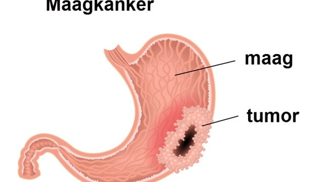 maagkanker.jpg
